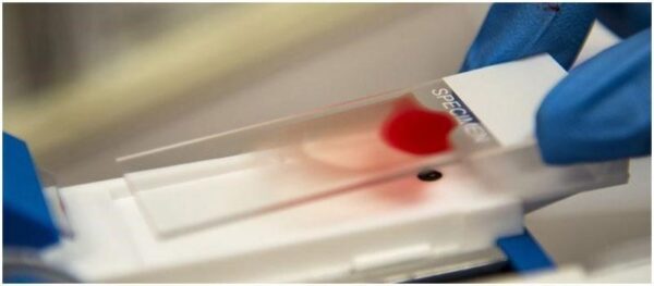 Unusual Blood Group Found in Rajkot Individual, Making It the 11th Known Case Worldwide